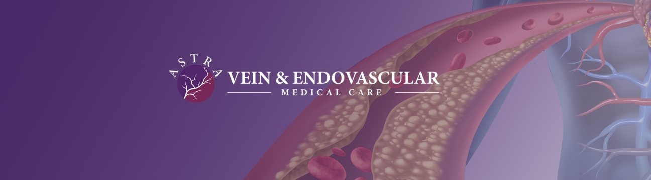 Advantages of Services in Astra Vein Treatment Center