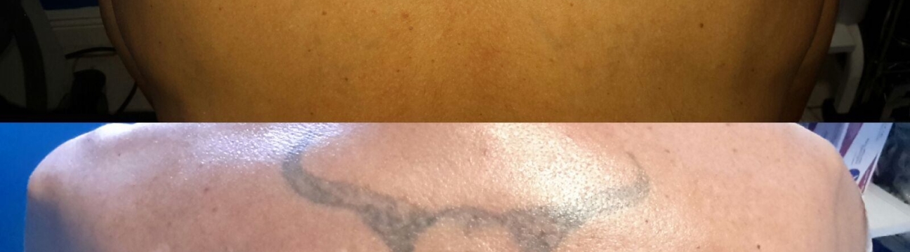 Winter Park  Tattoo Removal